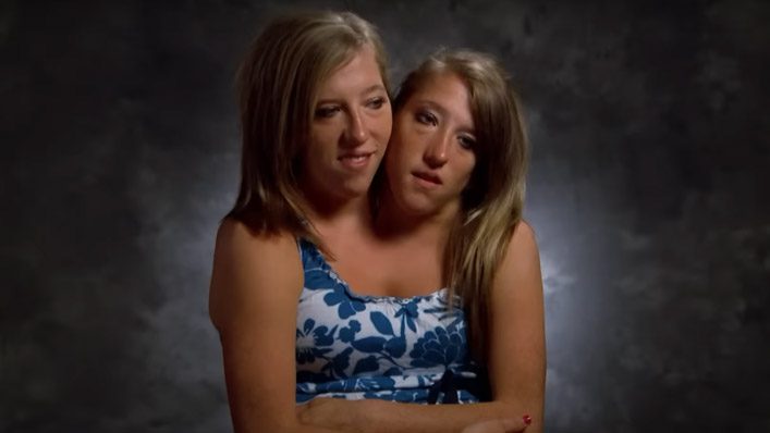 Inspiring Unity The Remarkable Story Of Conjoined Twins Abby