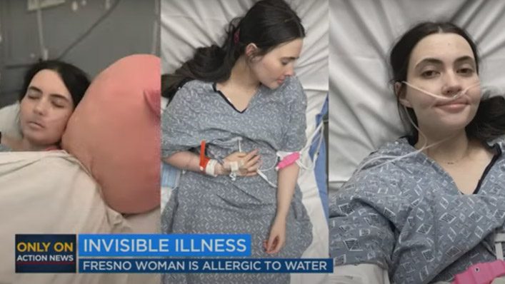 Brave Battle with Water: Tessa Hansen-Smith’s Life with Aquagenic Urticaria