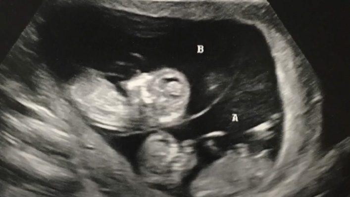 Truck Driver Kills Pastor’s Toddler & Unborn Baby—2 Yrs Later, His Wife’s Ultrasound Reveals Unbelievable News